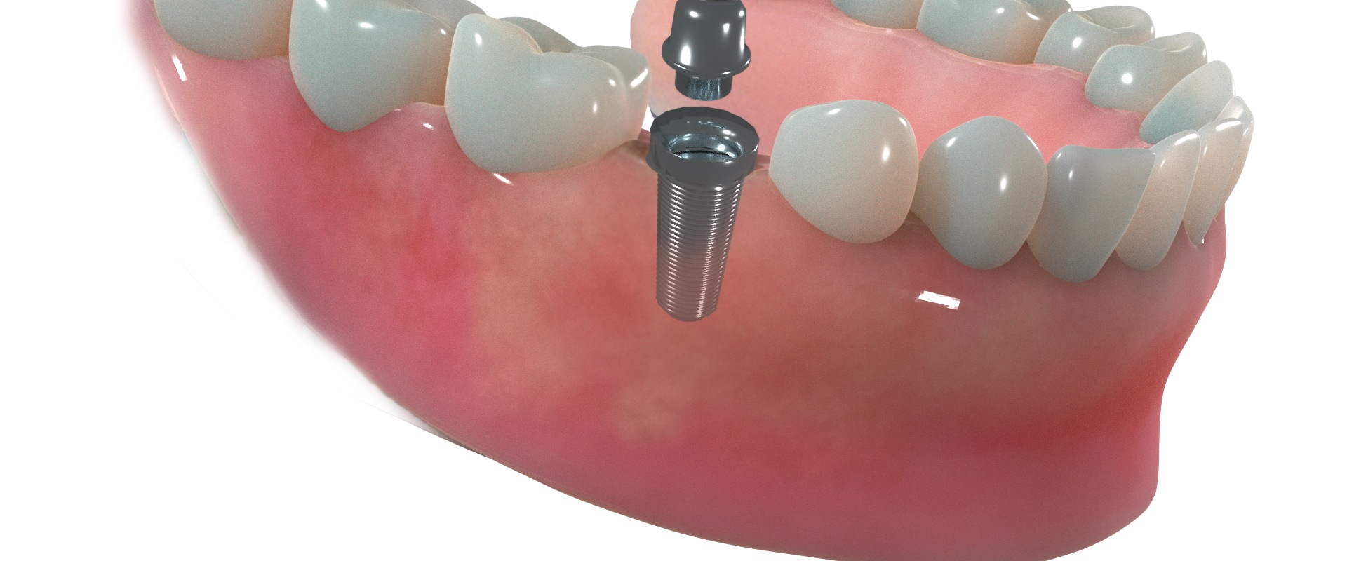 Revitalize Your Oral Health And Appearance With Dental Implants And Aesthetic Surgery In Austin, TX