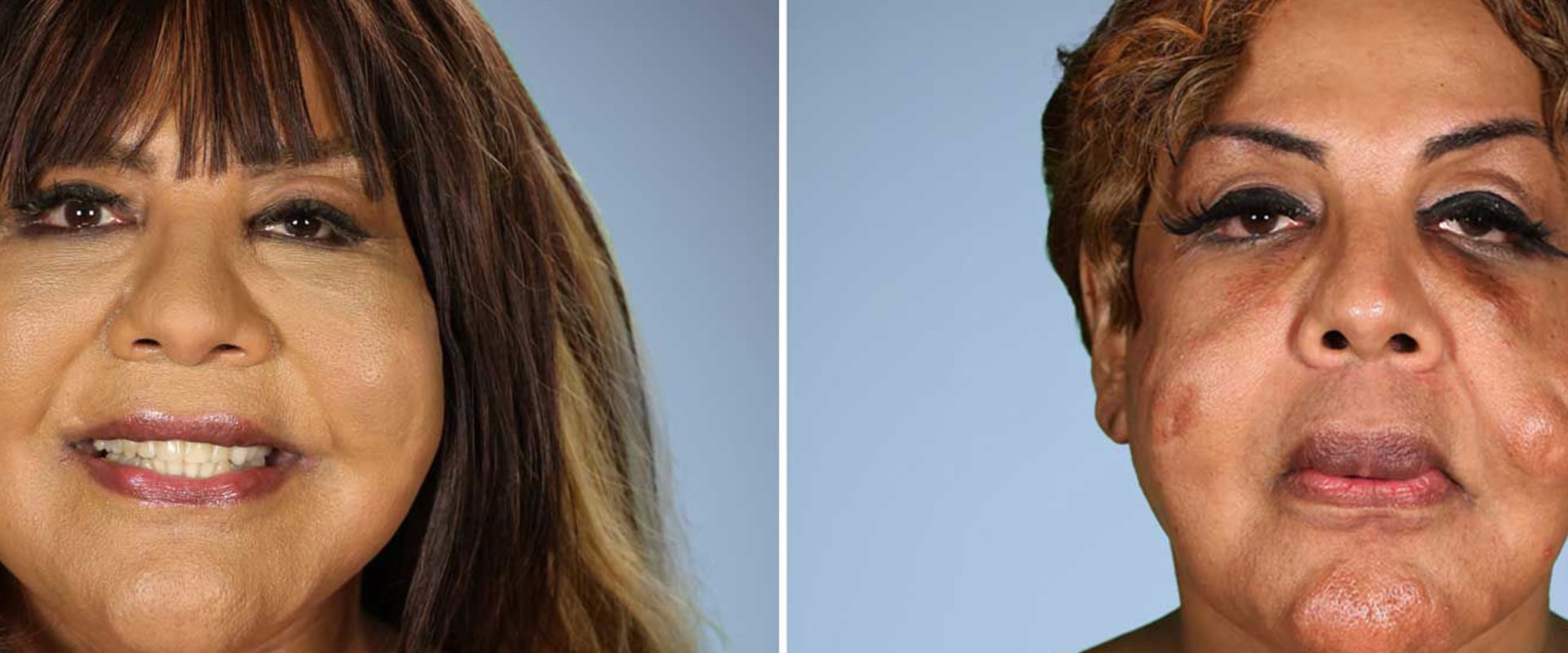 How Many Plastic Surgery Procedures Can Be Done At Once?