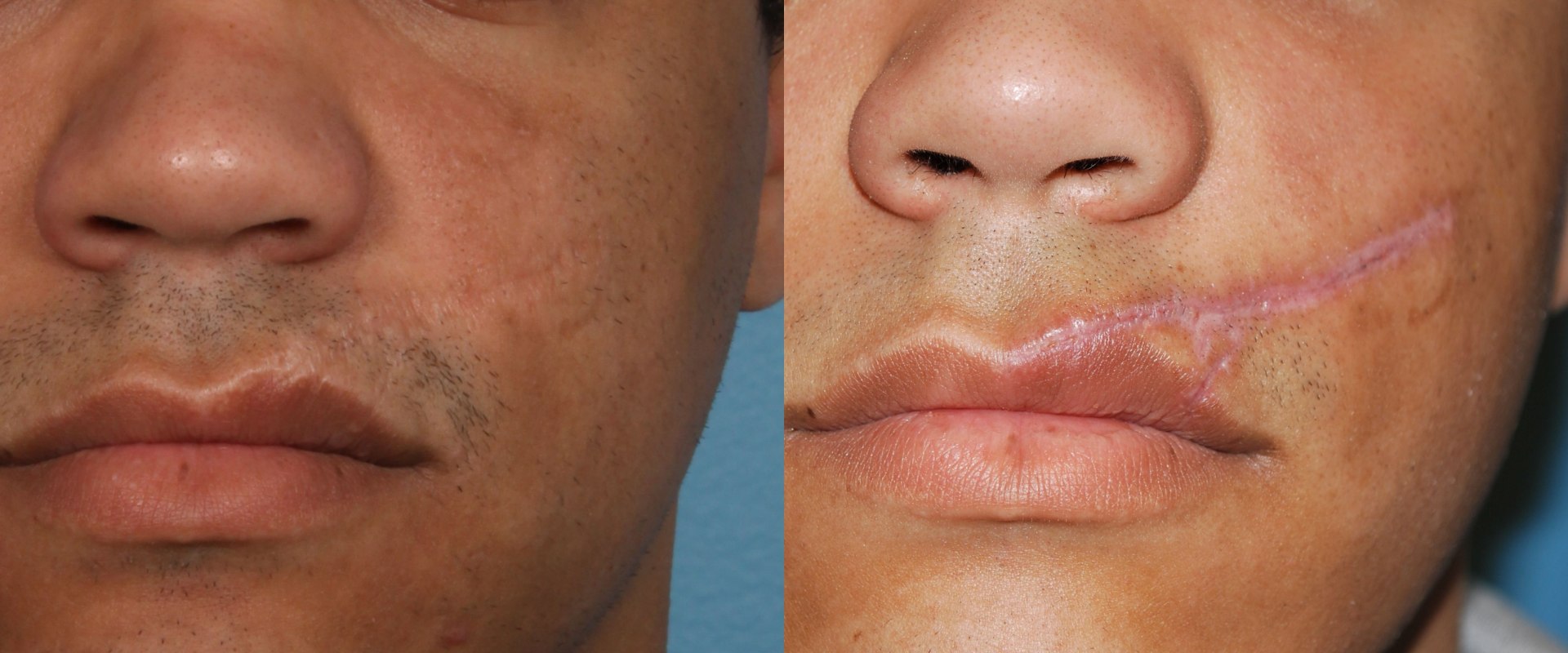 Getting Rid of Cosmetic Surgery Scars: What You Need to Know