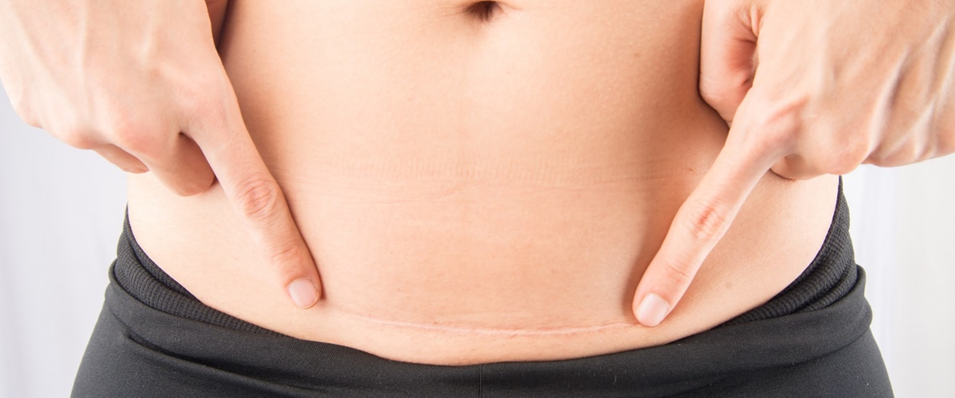 Minimizing Scarring After Aesthetic Surgery