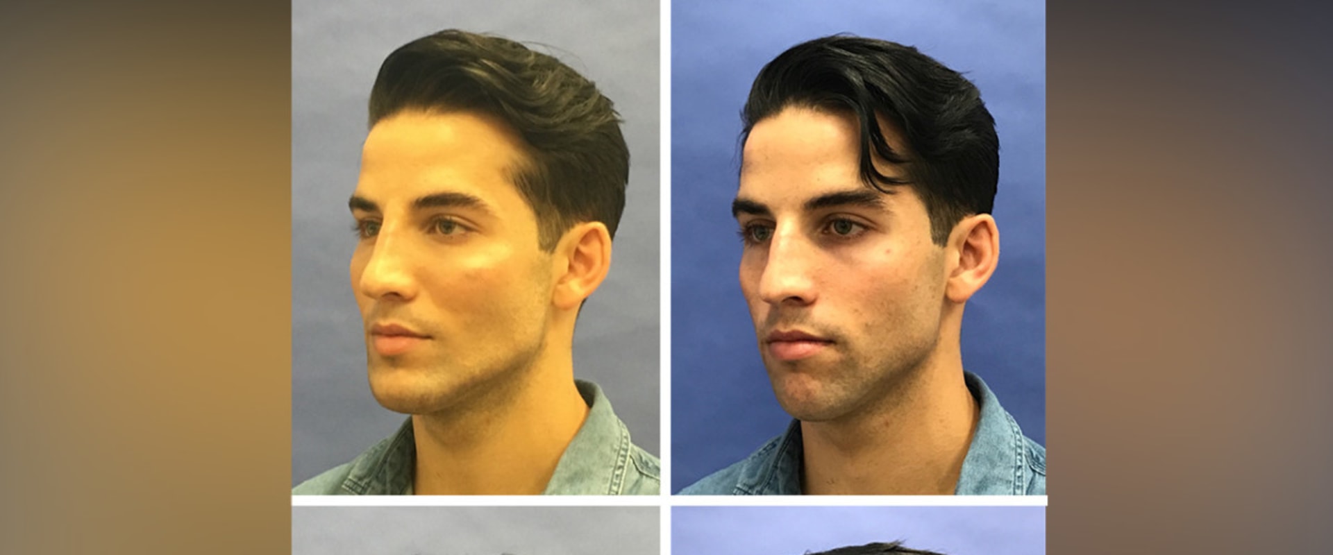 How Long Should You Wait Between Two Plastic Surgeries?