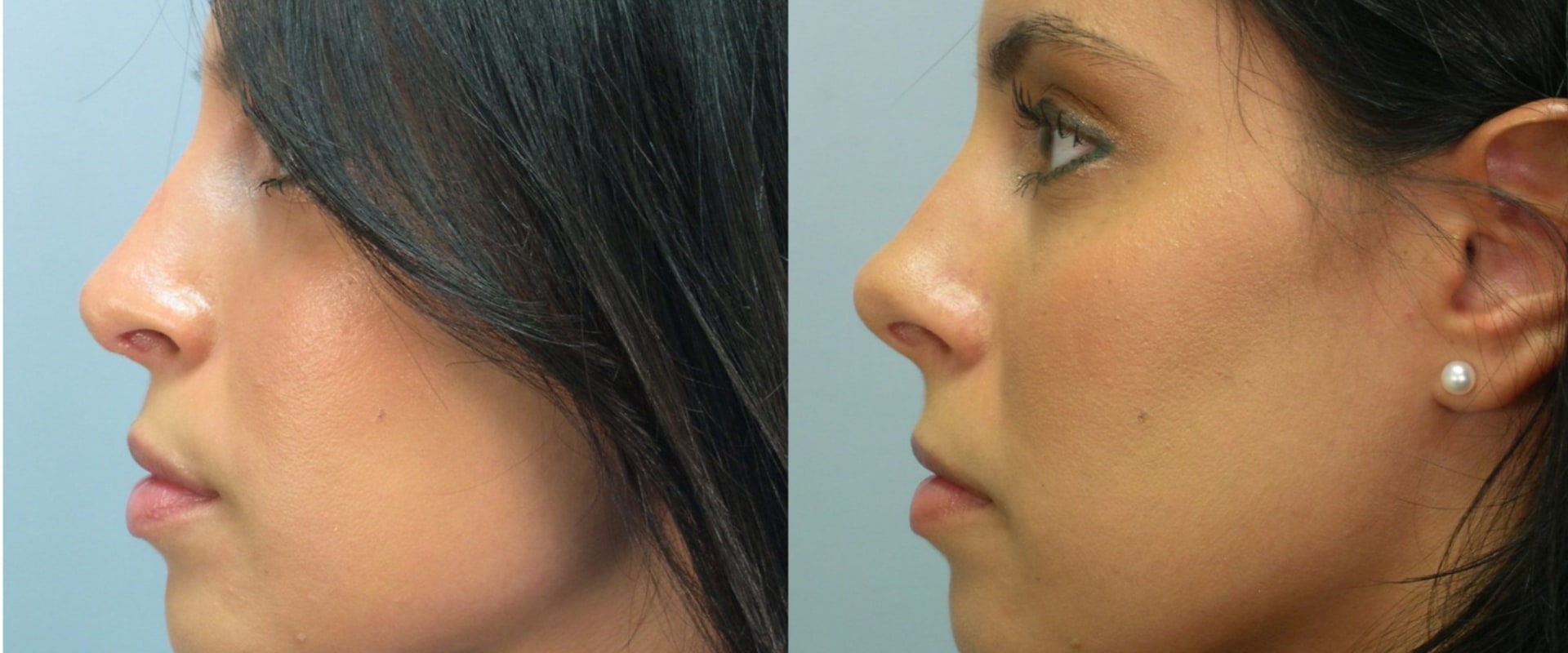 How Much Should You Budget for a Nose Job?