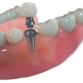 Revitalize Your Oral Health And Appearance With Dental Implants And Aesthetic Surgery In Austin, TX