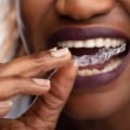 How Spark Aligners Can Complement And Enhance The Results Of Aesthetic Surgery In London