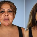 How Many Plastic Surgery Procedures Can Be Done At Once?