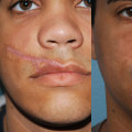 Getting Rid of Cosmetic Surgery Scars: What You Need to Know