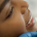 Enhancing Beauty, One Tooth At A Time: Dental Bonding In Round Rock's Aesthetic Surgery Scene