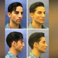 How Long Should You Wait Between Two Plastic Surgeries?