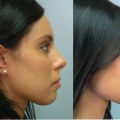 How Much Should You Budget for a Nose Job?