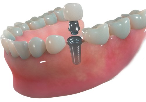 Revitalize Your Oral Health And Appearance With Dental Implants And Aesthetic Surgery In Austin, TX
