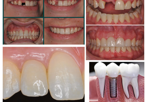 Emergency Dentist Services And Aesthetic Surgery For A Complete Smile Makeover In Pflugerville