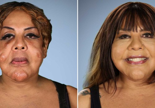 How Many Plastic Surgery Procedures Can Be Done At Once?
