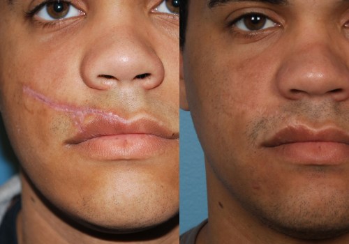 Getting Rid of Cosmetic Surgery Scars: What You Need to Know