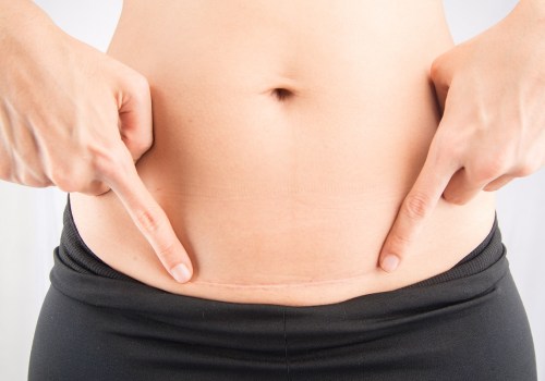 Minimizing Scarring After Aesthetic Surgery