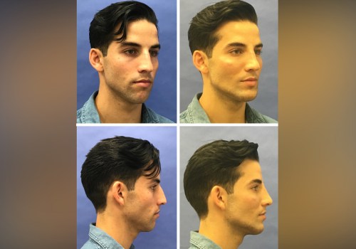 How Long Should You Wait Between Two Plastic Surgeries?