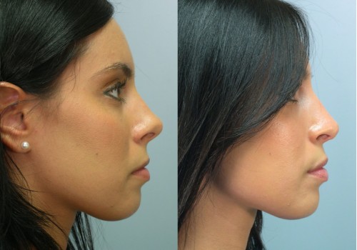 How Much Should You Budget for a Nose Job?